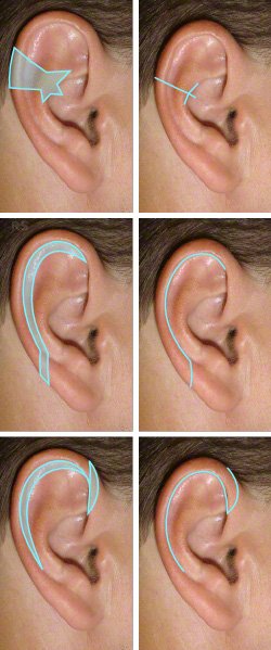Réduction des grandes oreilles — App RetouchMe